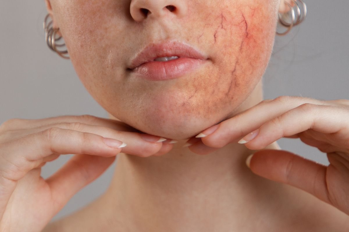 Rosacea Al Viso Sintomi Cause E Trattamenti Dott Ssa Eliana Lanza